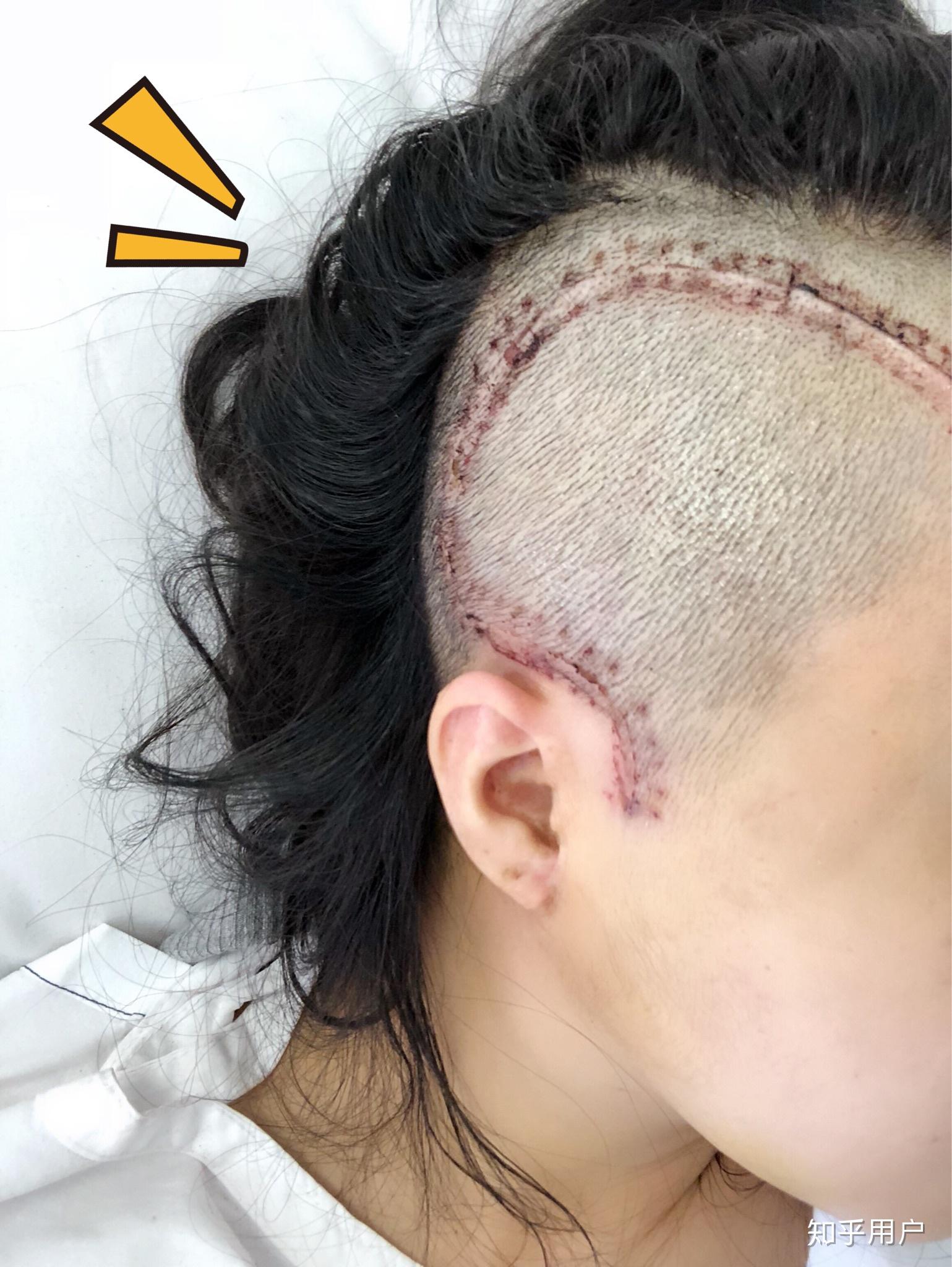 28岁脑出血,做了开颅手术,年轻人术后能恢复到什么程度? - 知乎