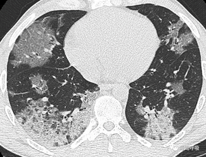 图片[28]-CHEST综述：机化性肺炎的诊断流程（临床-影像-病理特征相关性） | 每周呼吸-每周呼吸