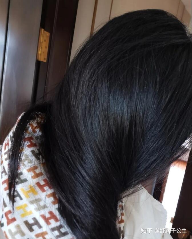 20多岁女孩子脱发严重是什么感受