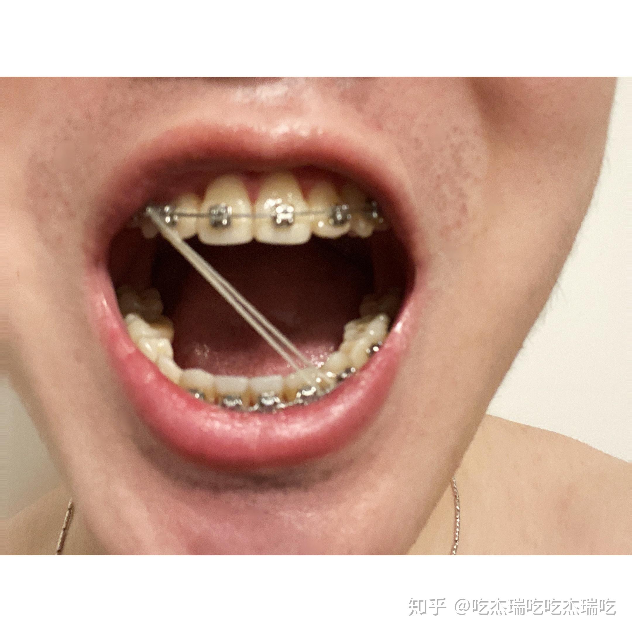 写回答 登录/注册 牙齿 牙齿正畸 矫正 牙齿矫正方法 隐形牙齿矫正