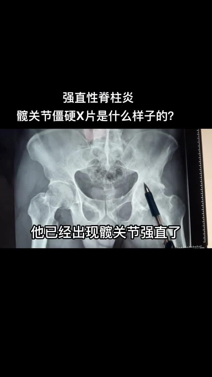强直性脊柱炎髋关节僵硬x片