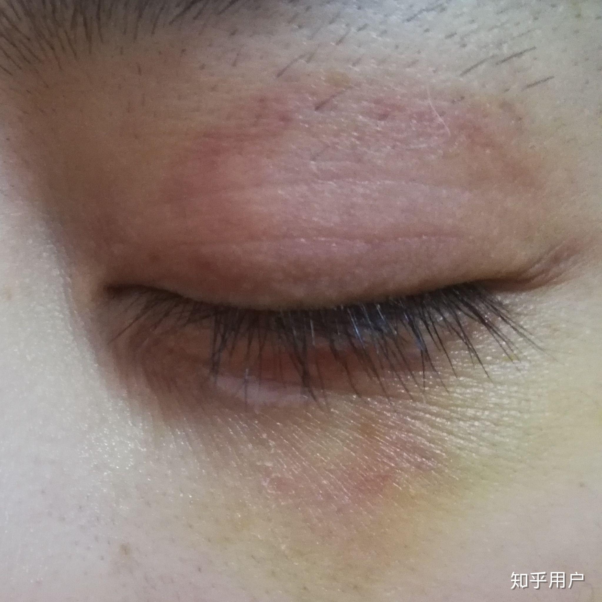 想知道眼部淤青怎么可以快速消除