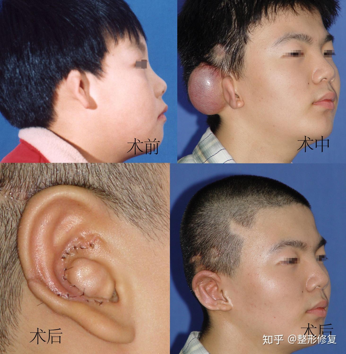 畸形耳朵治疗费用价格贵吗? - 知乎