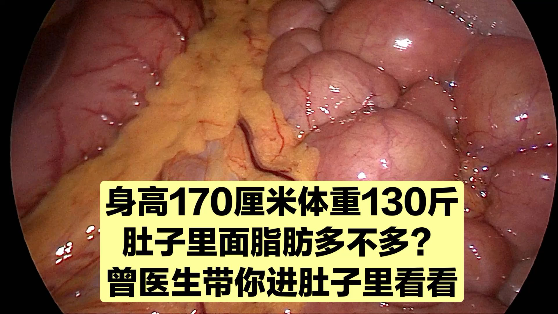 身高170厘米体重130斤居然也有脂肪肝来看肚子里的油