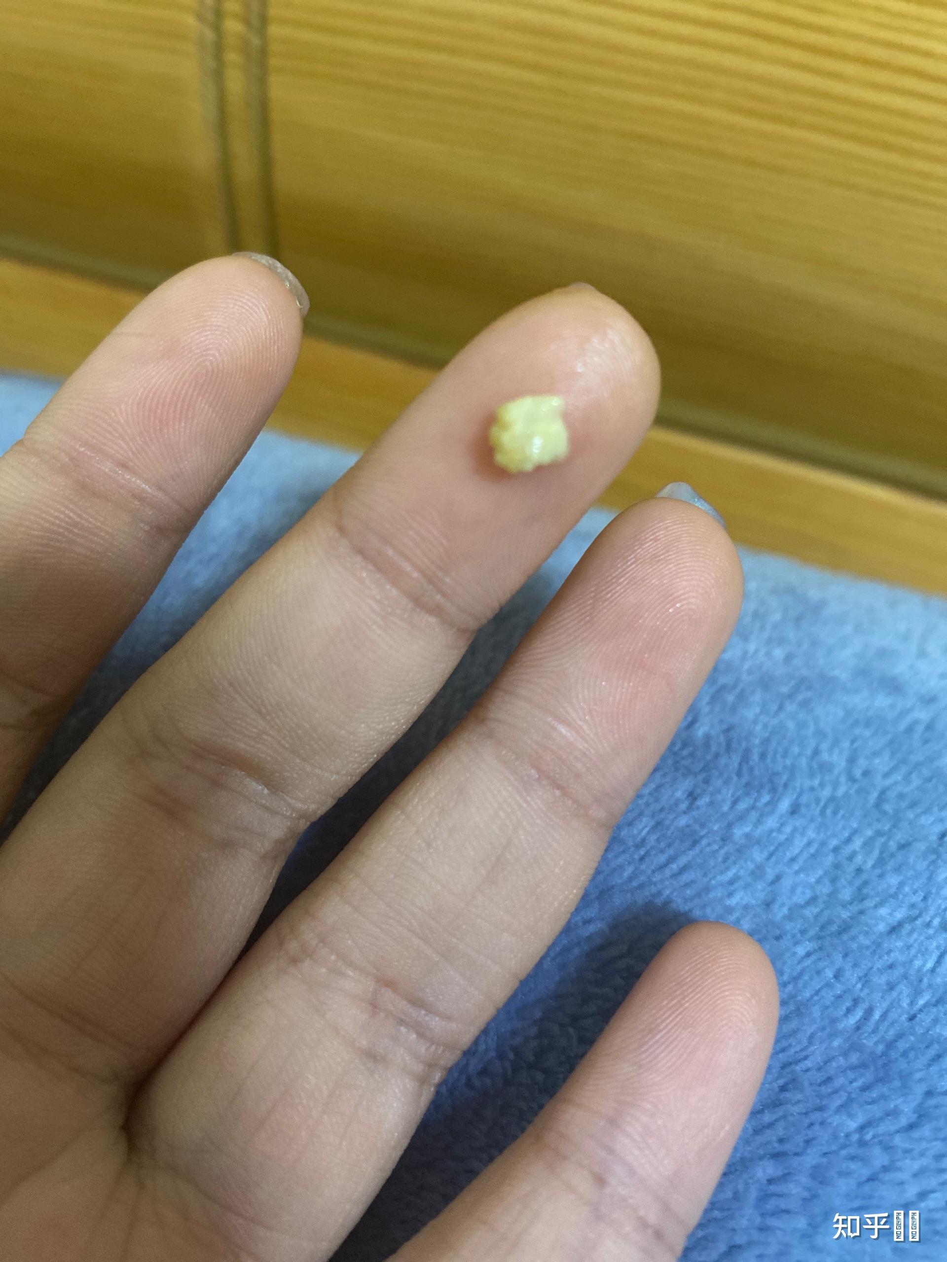 喉咙里经常有黄白色的臭臭的东西跑出来,那是什么? - 知乎