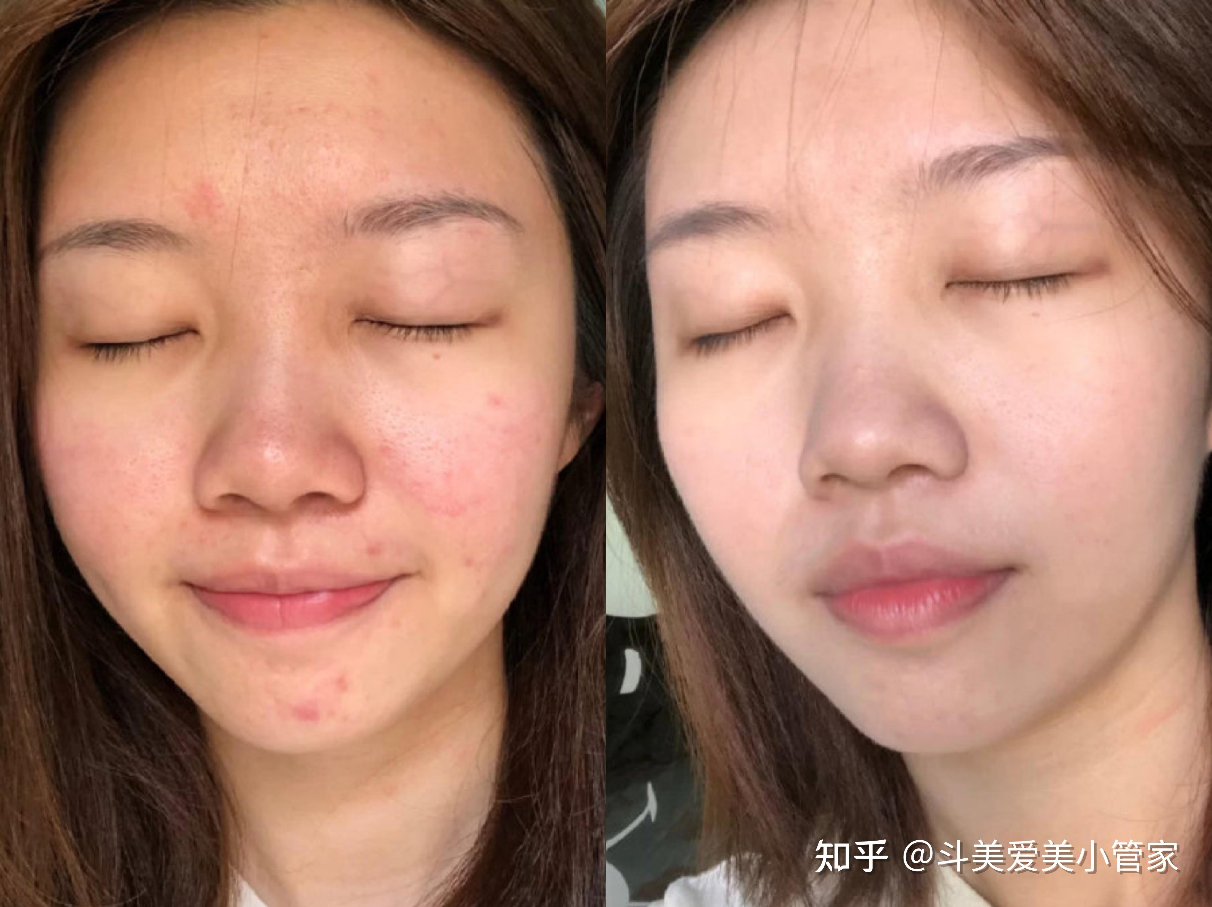 广州有哪些比较好的光子嫩肤医院推荐