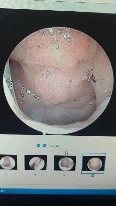 过敏性鼻炎合并腺样体肥大为什么要中医治疗