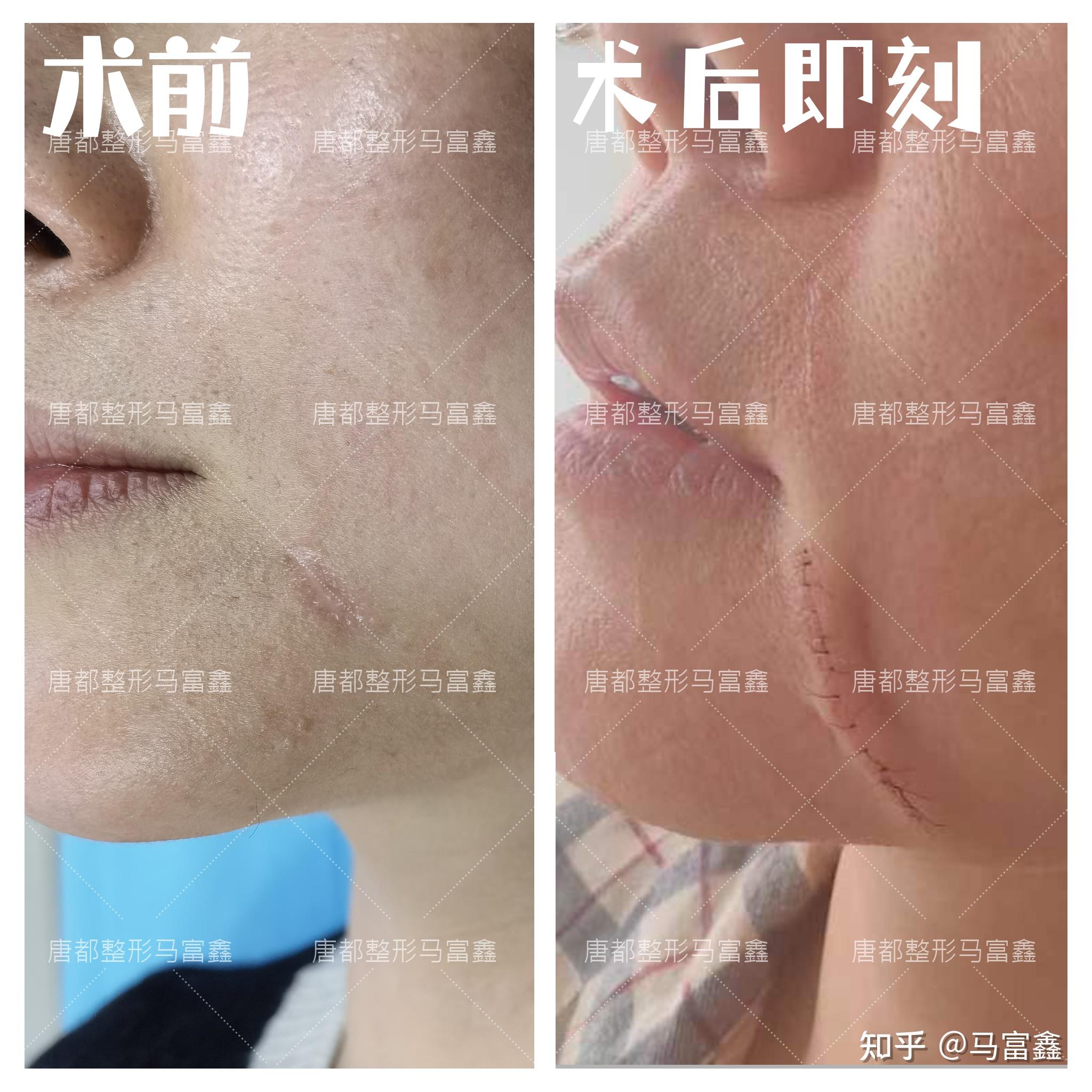 颏部疤痕手术