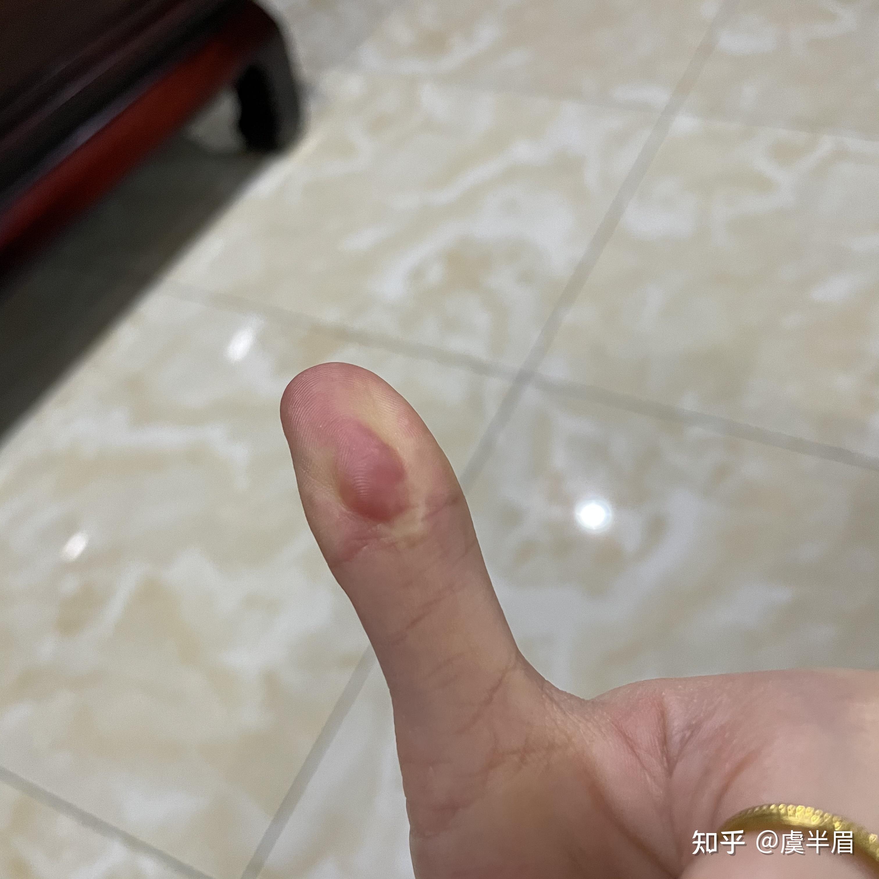 手指被刀削去一块肉,贴回去可以长好么? - 知乎