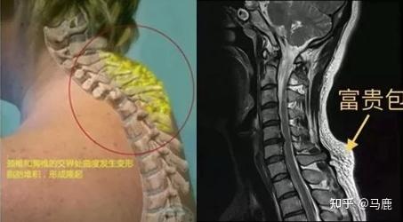 怎么去颈椎包? - 知乎