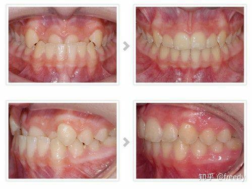 为什么人类咬紧牙齿的时候大牙对齐门牙对不齐门牙对齐大牙对不齐