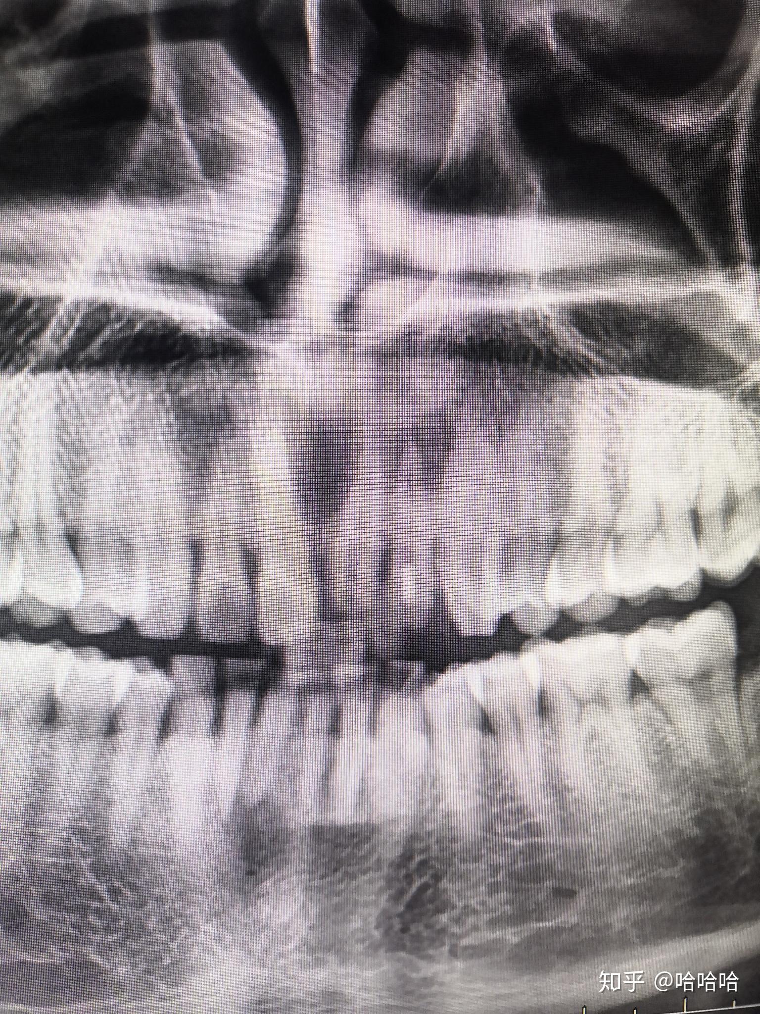 根尖囊肿是硬的吗? - 知乎