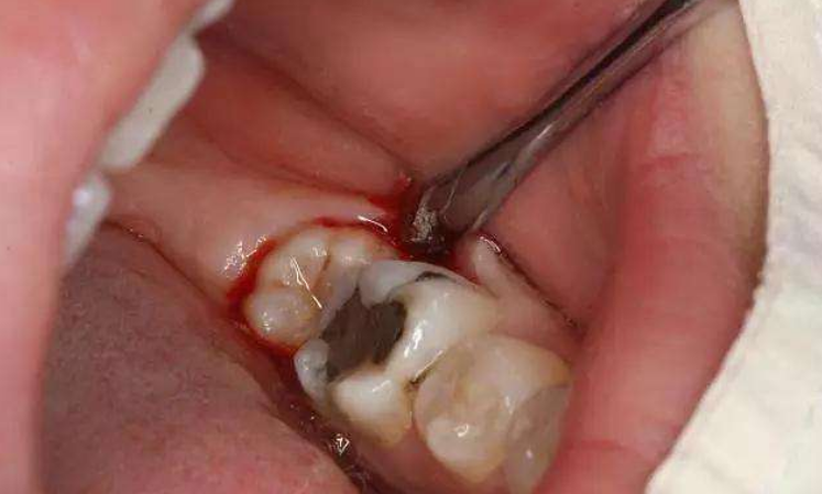 拔牙后血凝块里面有食物残渣怎么处理? 