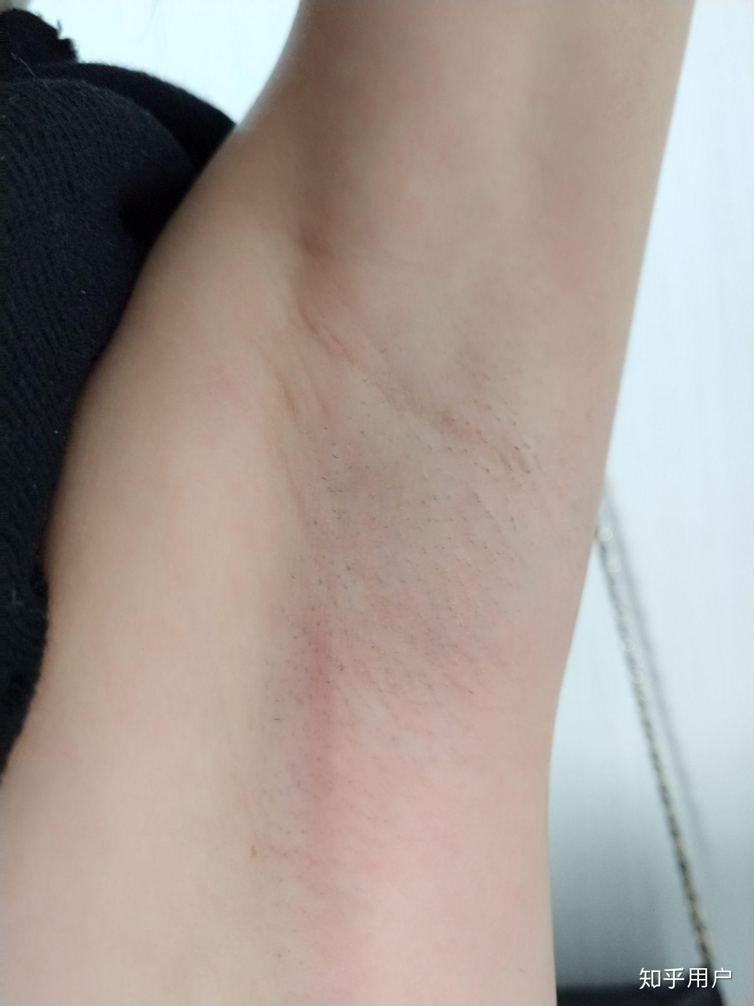 做腋下大汗腺切除手术是什么体验? - 知乎