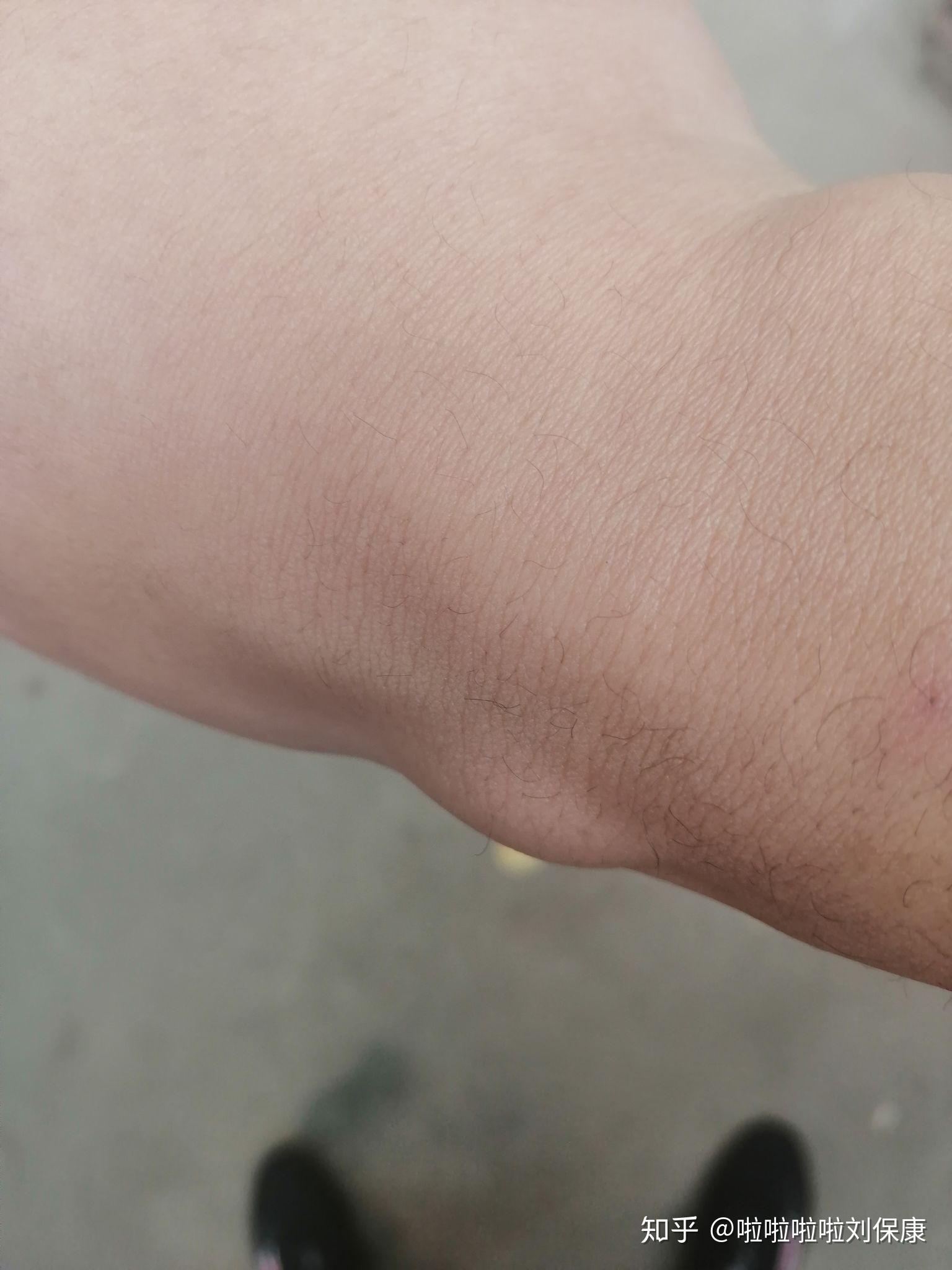 手腕腓骨端有个肿包怎么恢复最近玩腹肌轮