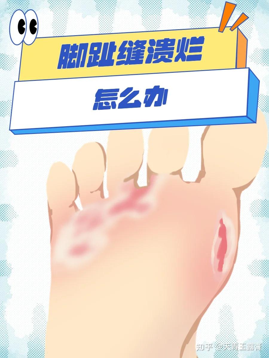 最近脚特别痒,用什么药可以根治? - 知乎