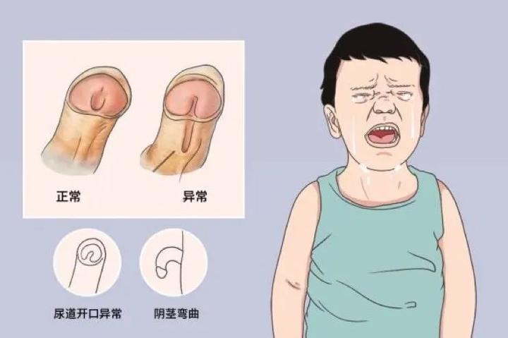怎么判断孩子是否有尿道下裂?(男孩家长必看)