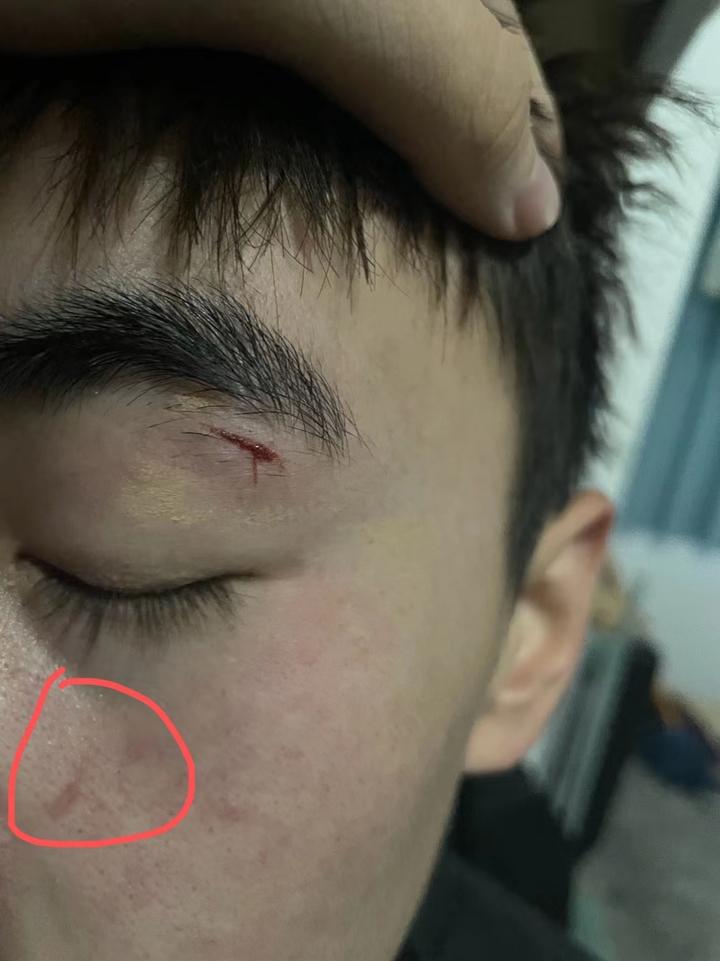 curtain之前被指甲抓伤,掉了一层皮,结痂之后脱落了,不知道啥时候红色