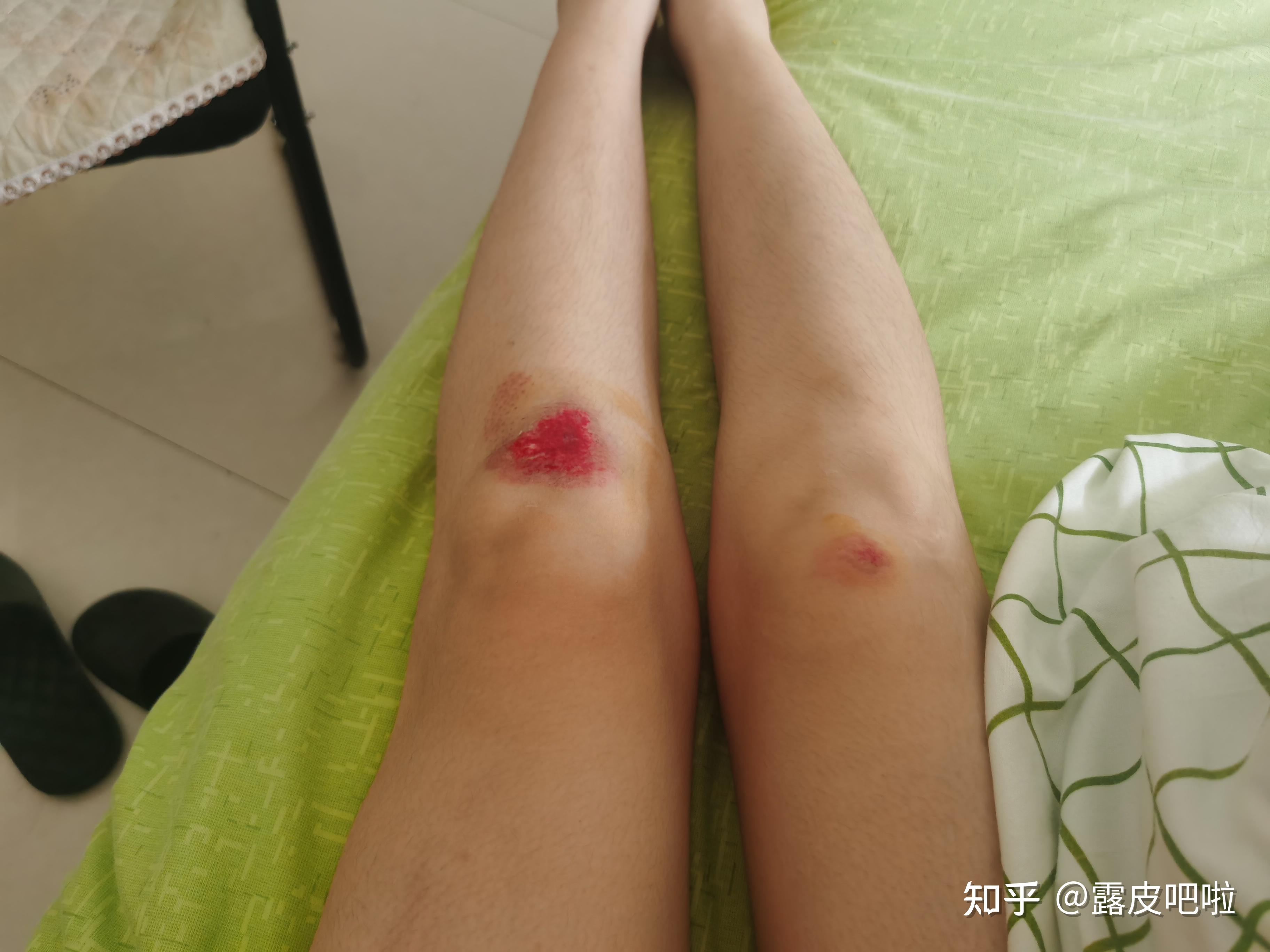 大面积擦伤掉痂以后皮肤呈紫红色