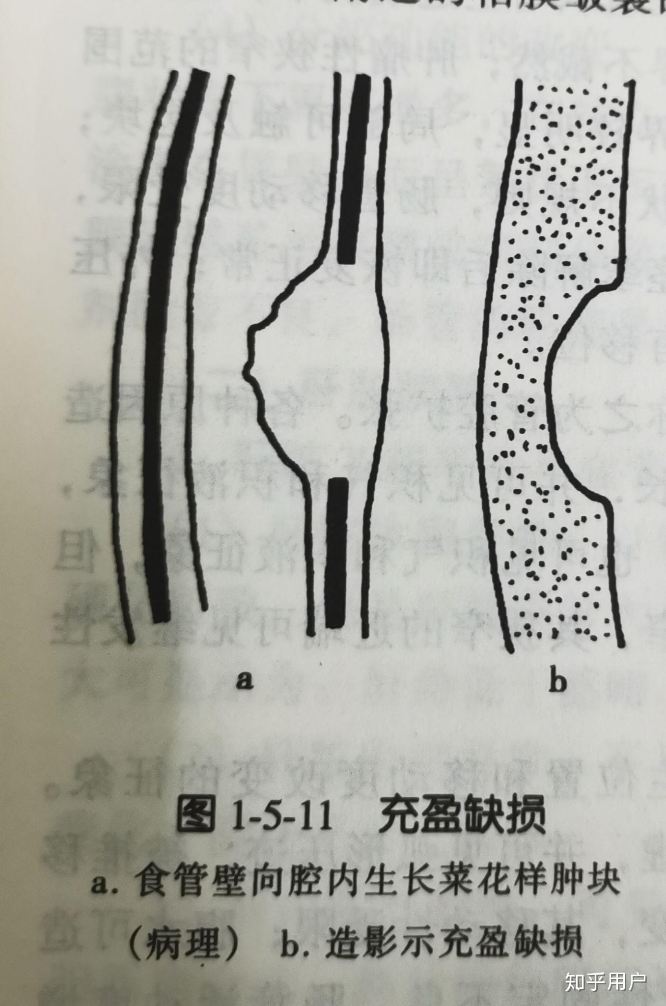 恶性龛影和充盈缺损都是向内凹陷的,那它们怎么区别呢?
