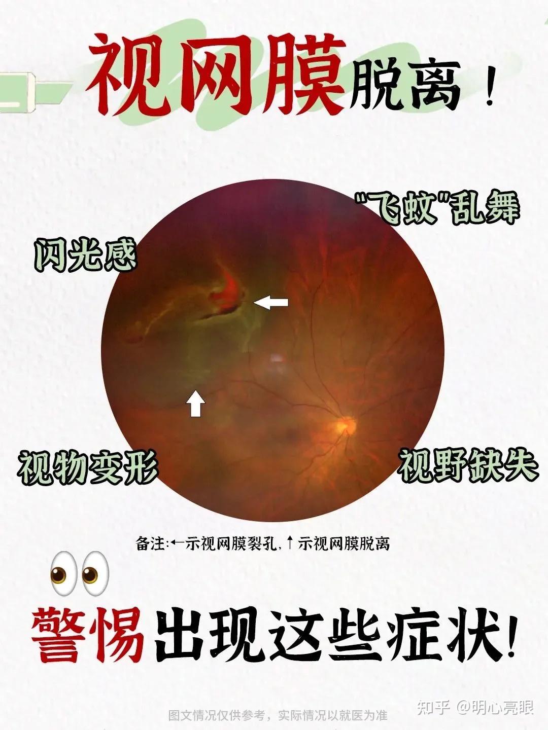 导致视网膜脱落的原因是什么?