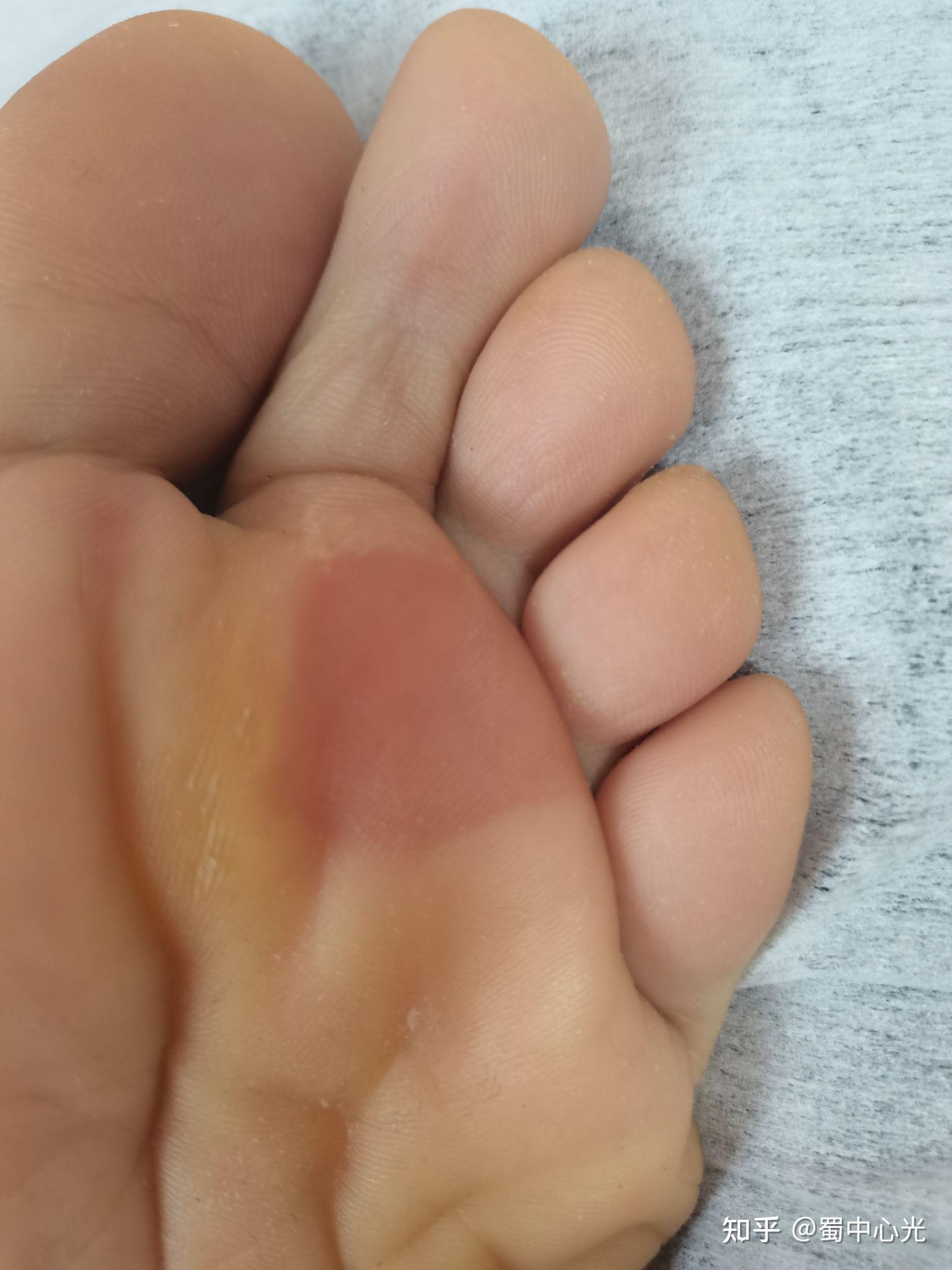 为什么徒步脚会起水泡?