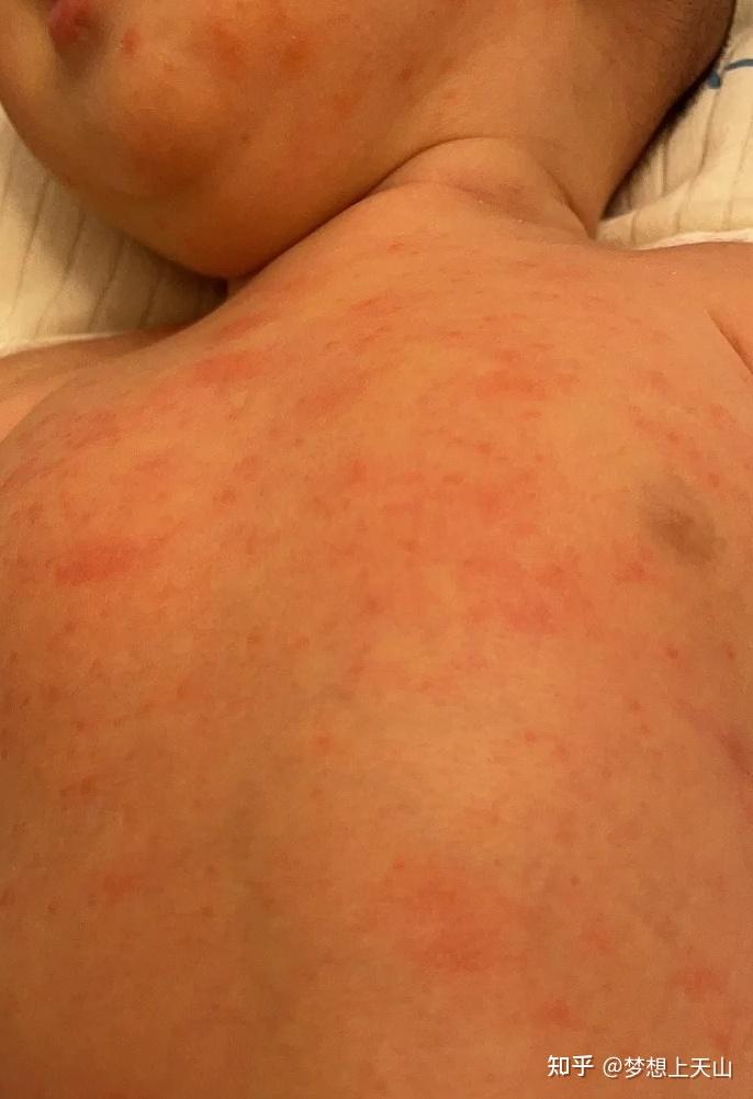 宝宝身上容易起痱子怎么办?