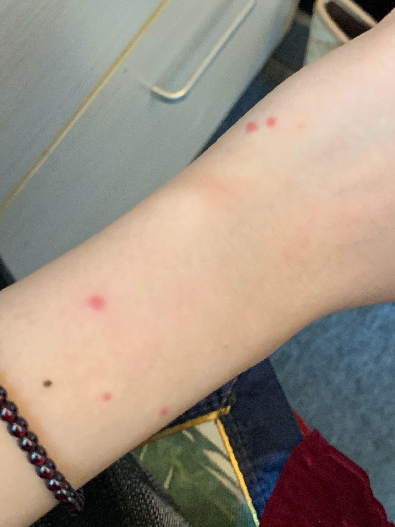 大家有被蚊子叮包后的奇葩照片吗? - 知乎