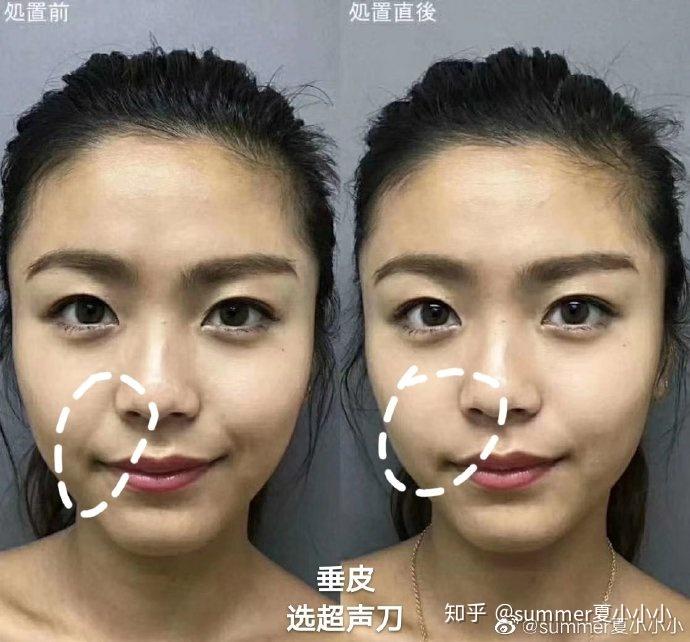 37岁的宝妈,面部有些下垂,请问做热玛吉好还是热拉提,还是超声刀?