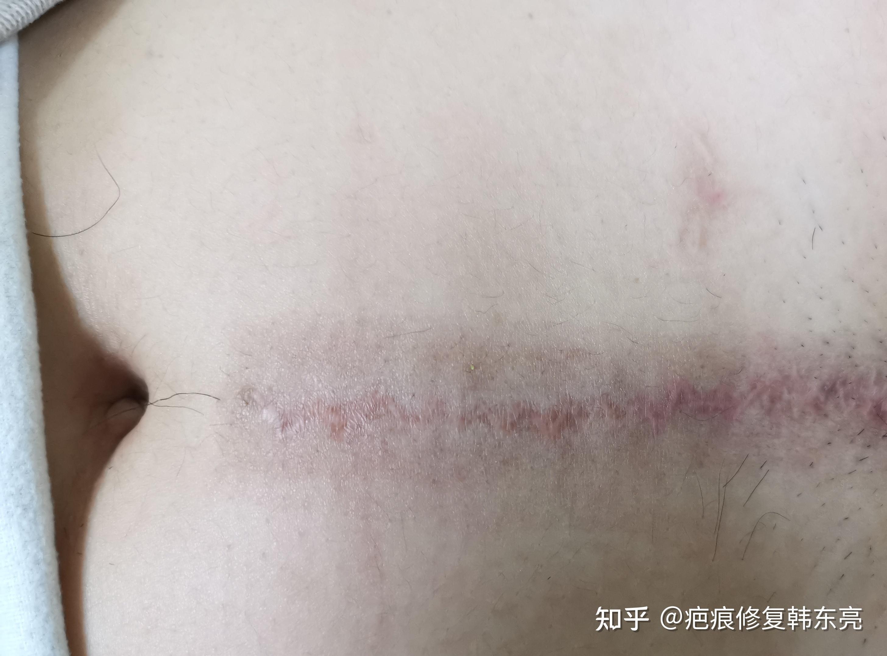 手术后疤痕怎么办?好丑好长一条啊? - 知乎