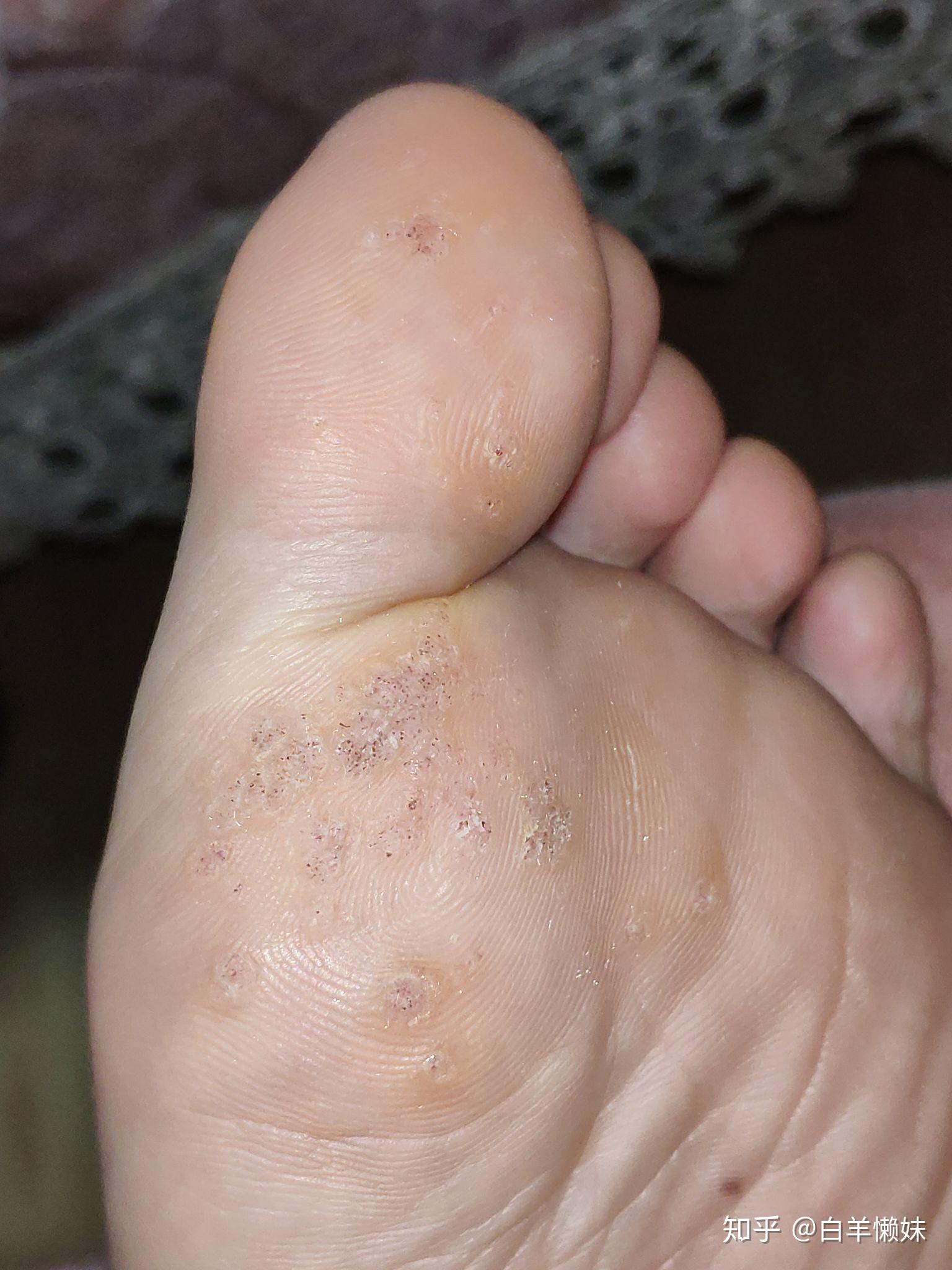 脚上长了跖疣怎么办? - 知乎