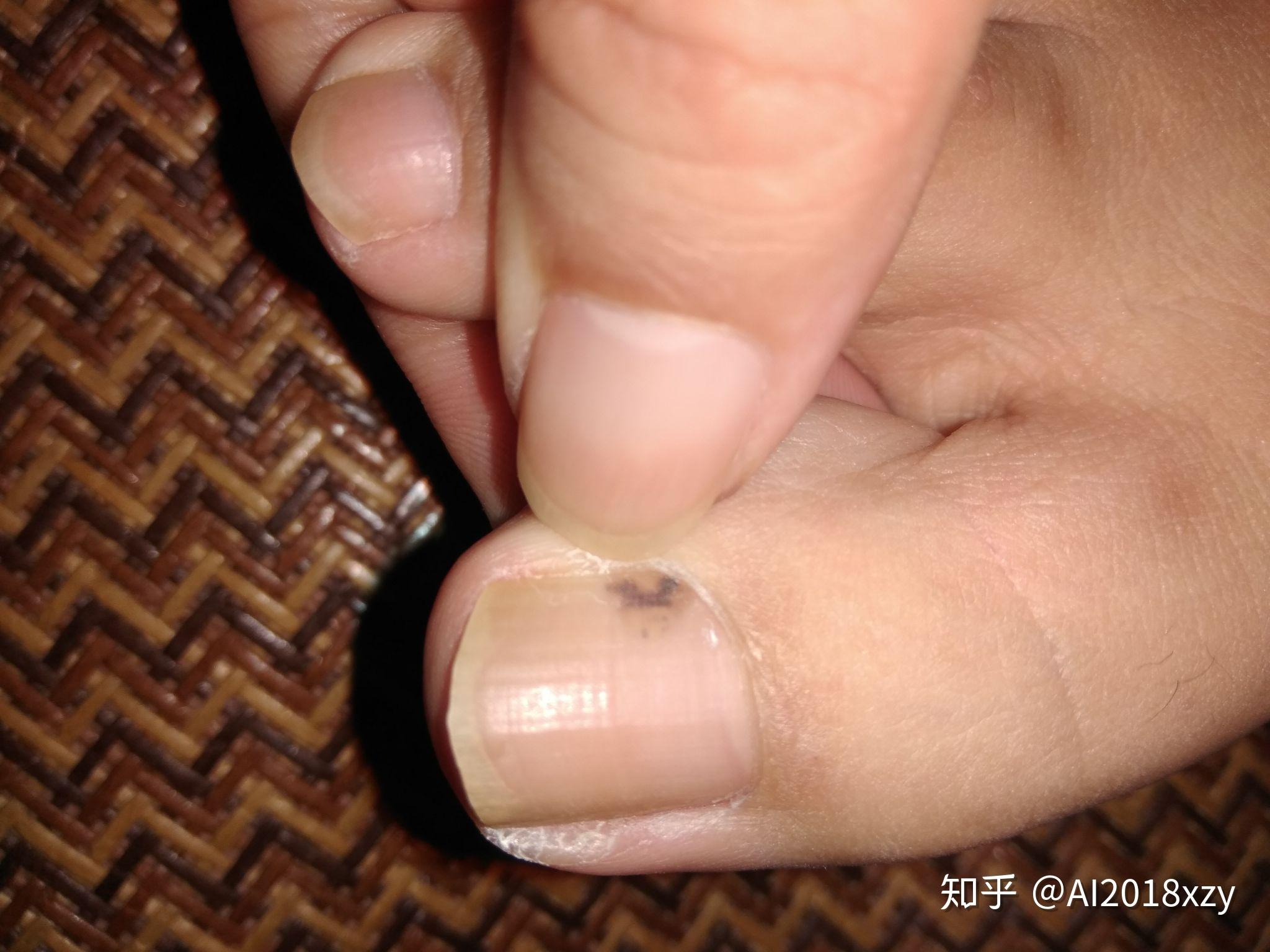 脚指甲黑色素瘤照片图片