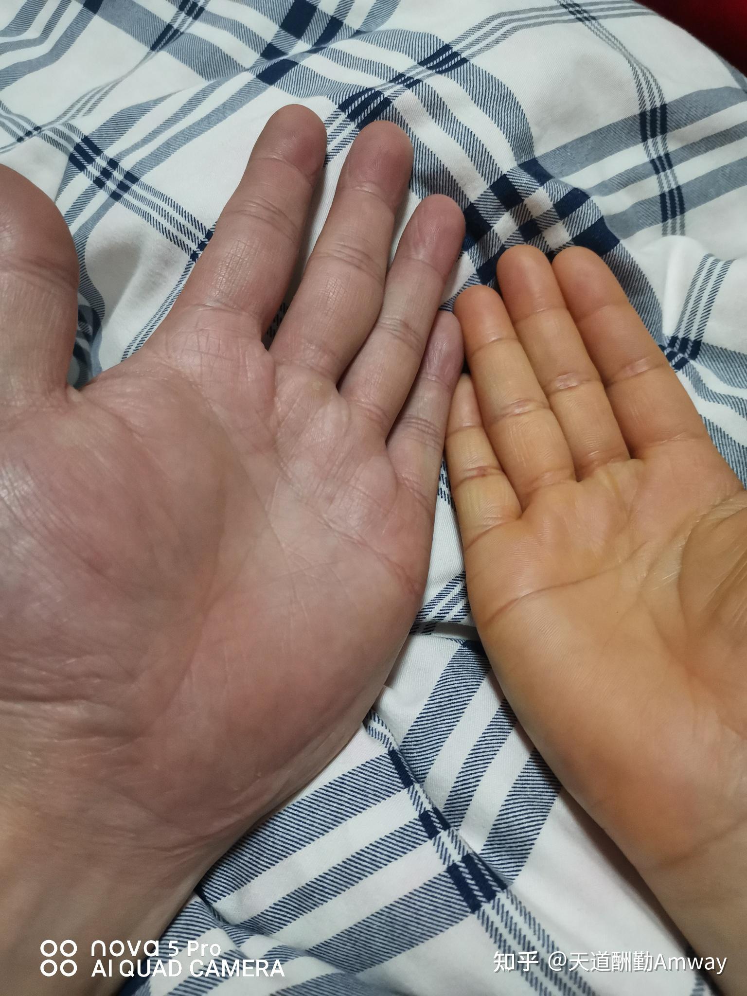 手脚发黄但身体正常是怎么回事