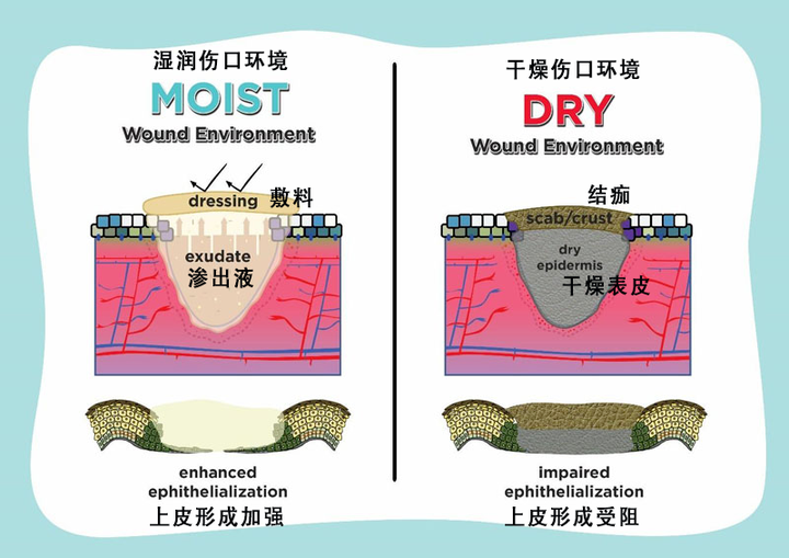 99%的人依然不知道什么叫「湿性愈合」,所以伤口好得贼慢还留疤 - 知乎