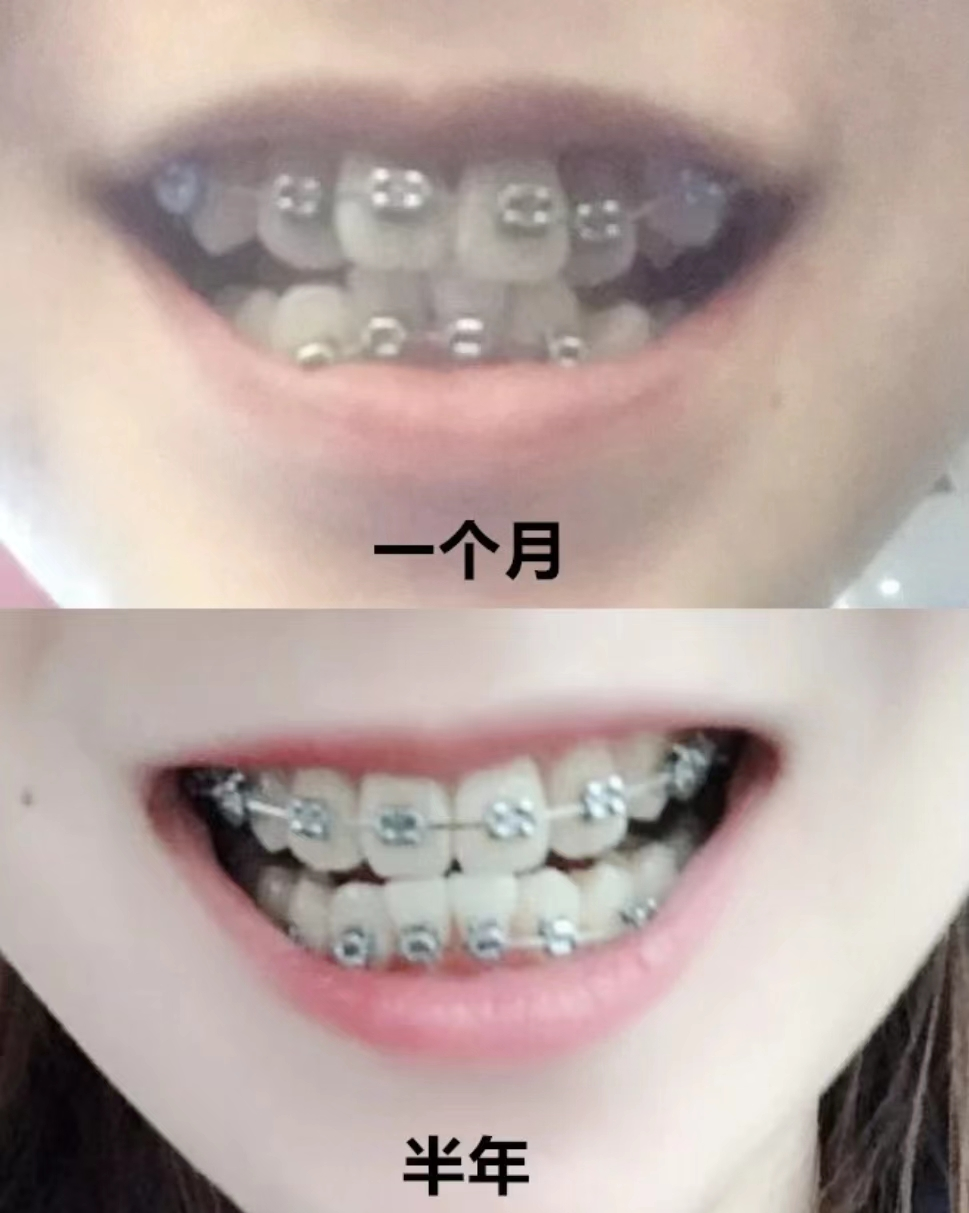 牙齿歪斜参差不齐,但咬合正常,也并没有影响外表形态,有必要矫正吗?