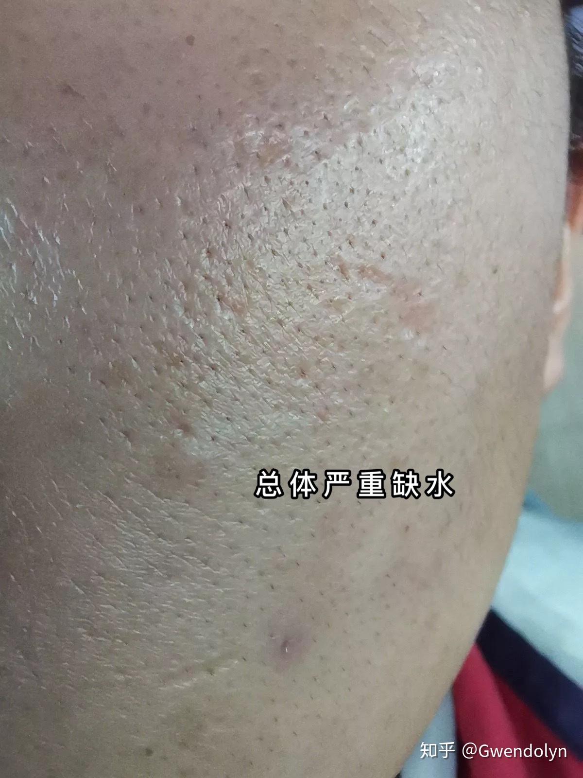 我这种脸到底是干皮造成的毛孔粗大还是油皮造成的毛孔粗大啊