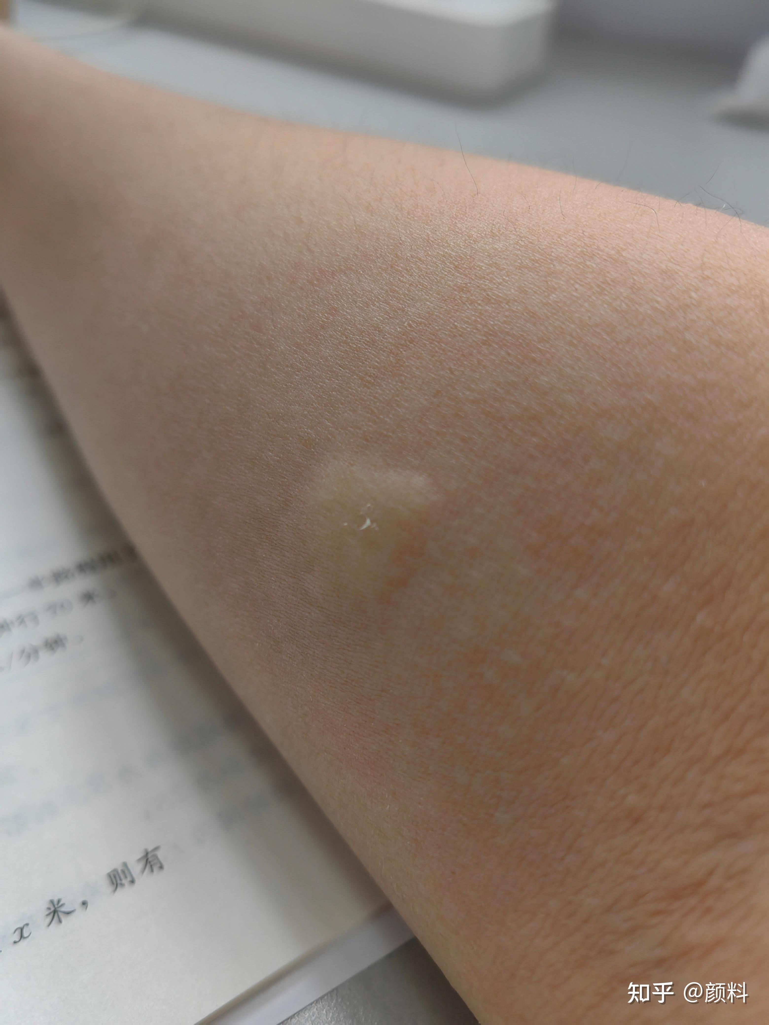 为什么我被蚊子咬了之后那个小包会越来越大像那一块肿了一样