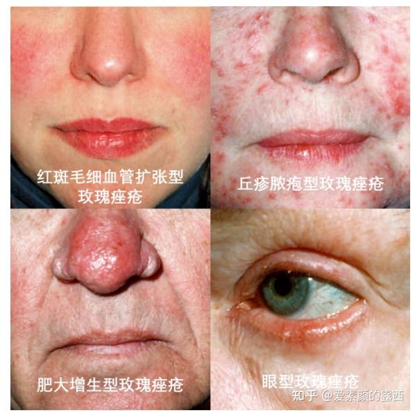 脂溢性皮炎痤疮和玫瑰痤疮如何判断