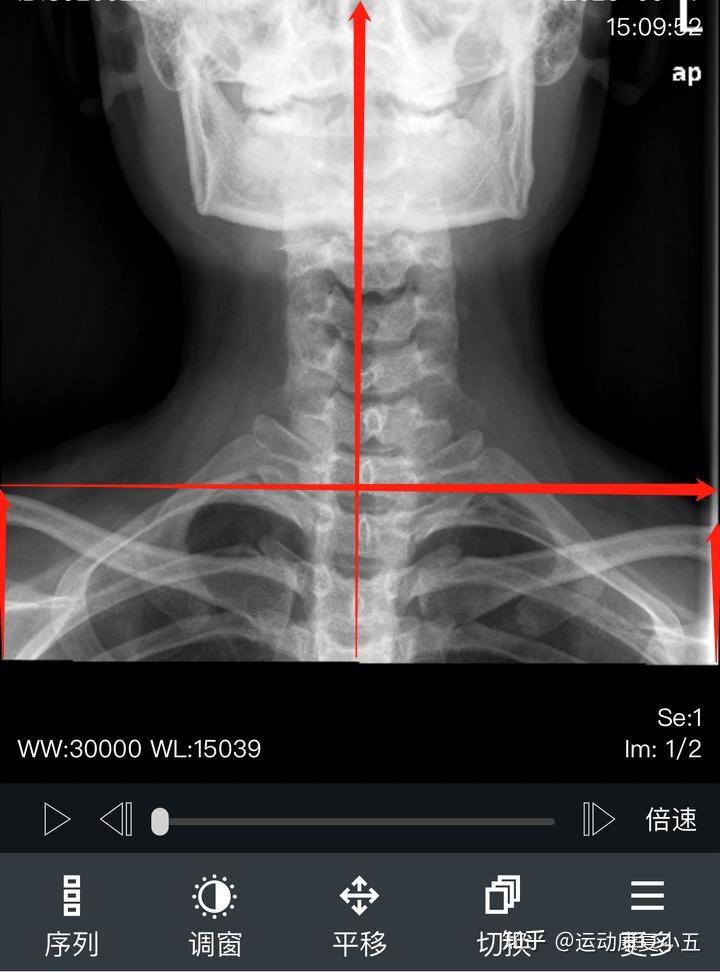 请问有会看这颈部x光片吗?