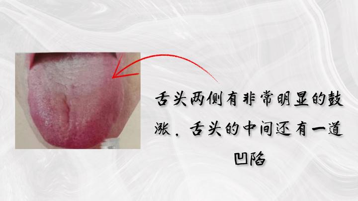 肝不好,病来找,肝郁怎么参考中成药?医生通过舌象告诉你答案 - 知乎