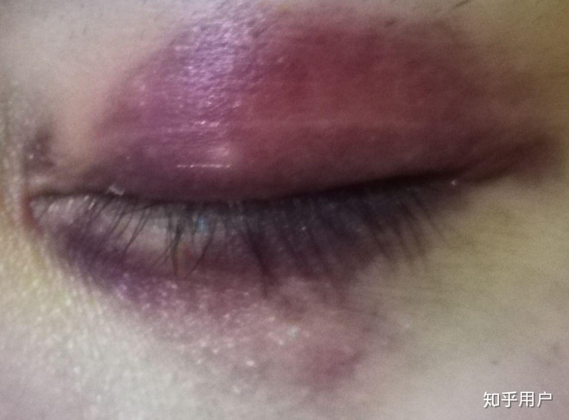 想知道眼部淤青怎么可以快速消除