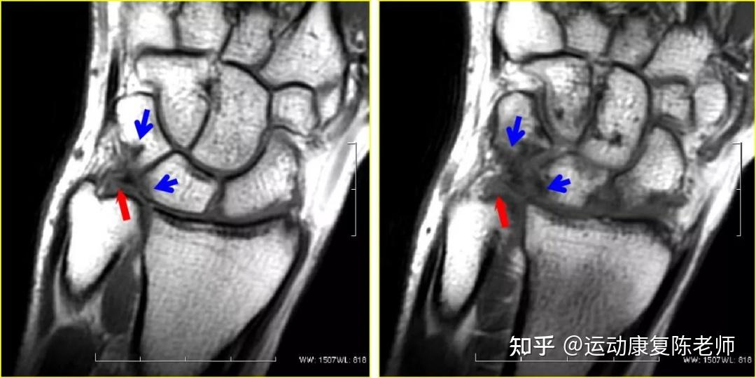重量训练导致的手腕疼痛如何康复? - 知乎