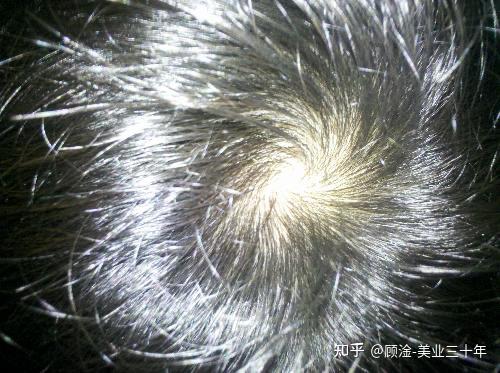 我的这个发旋处的发量是正常的吗？ - 知乎