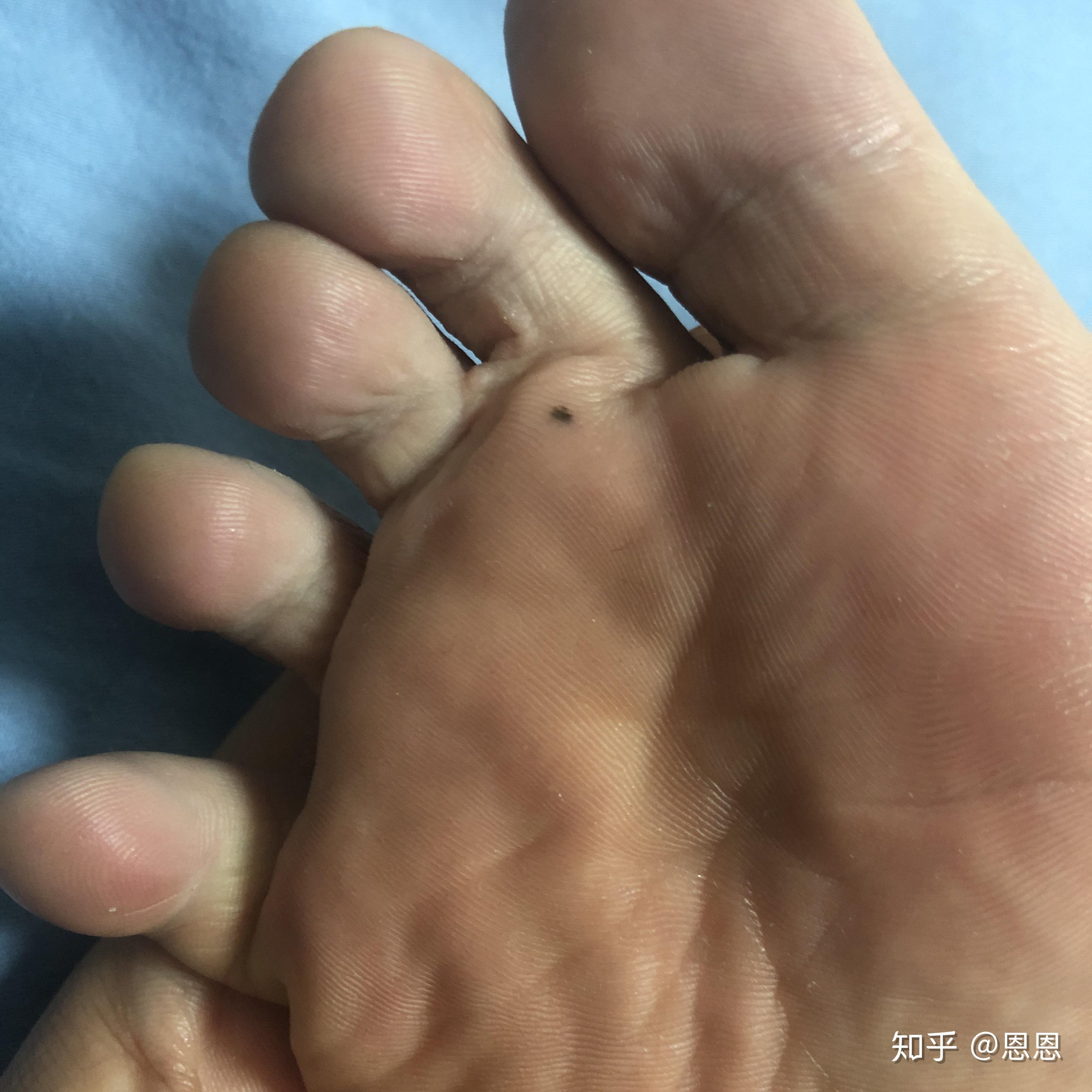 脚底板长了一颗痣