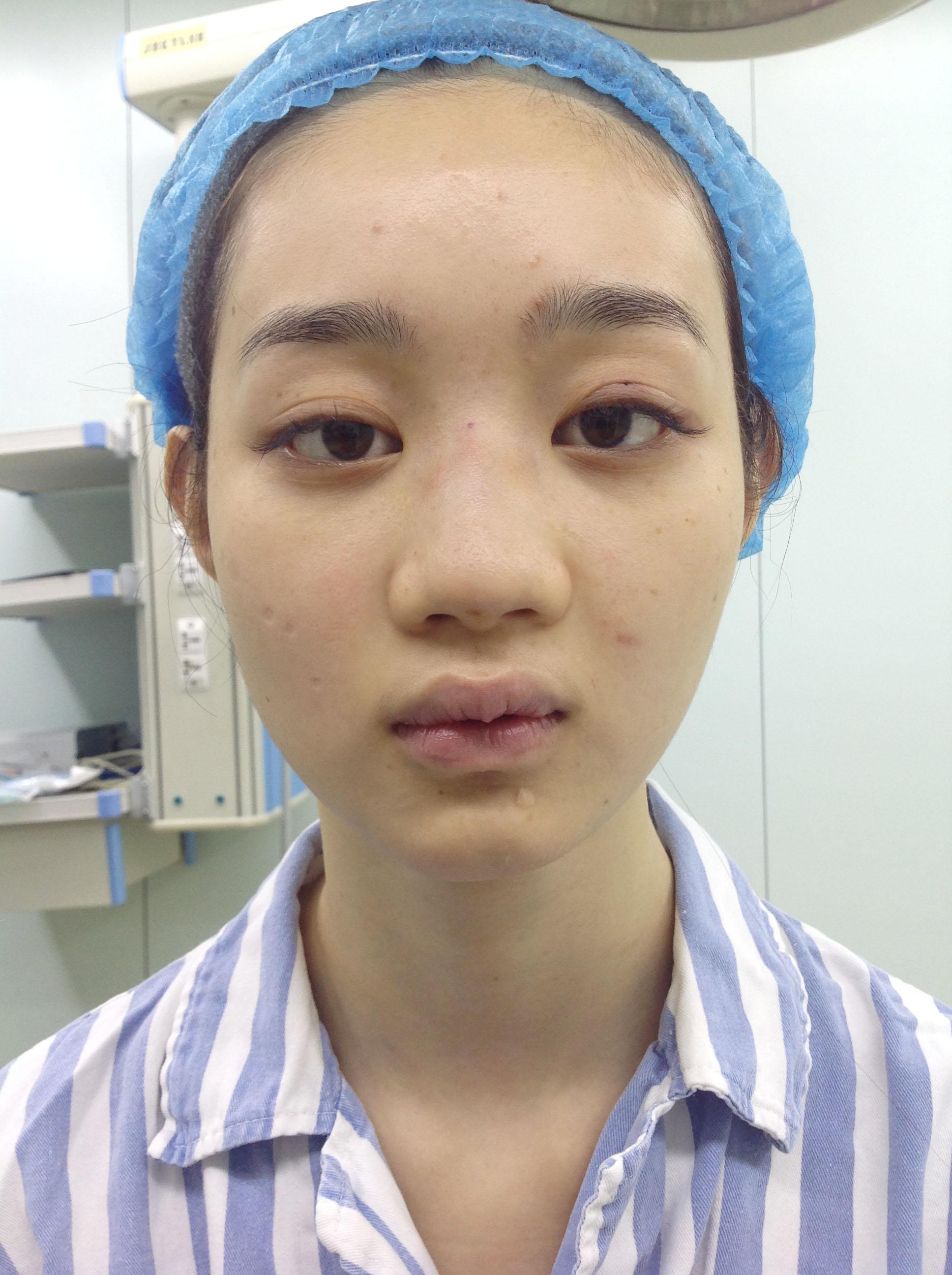 从鼻塞引发的一场功能性鼻整形-健康教育-清华大学附属北京清华长庚医院整形外科