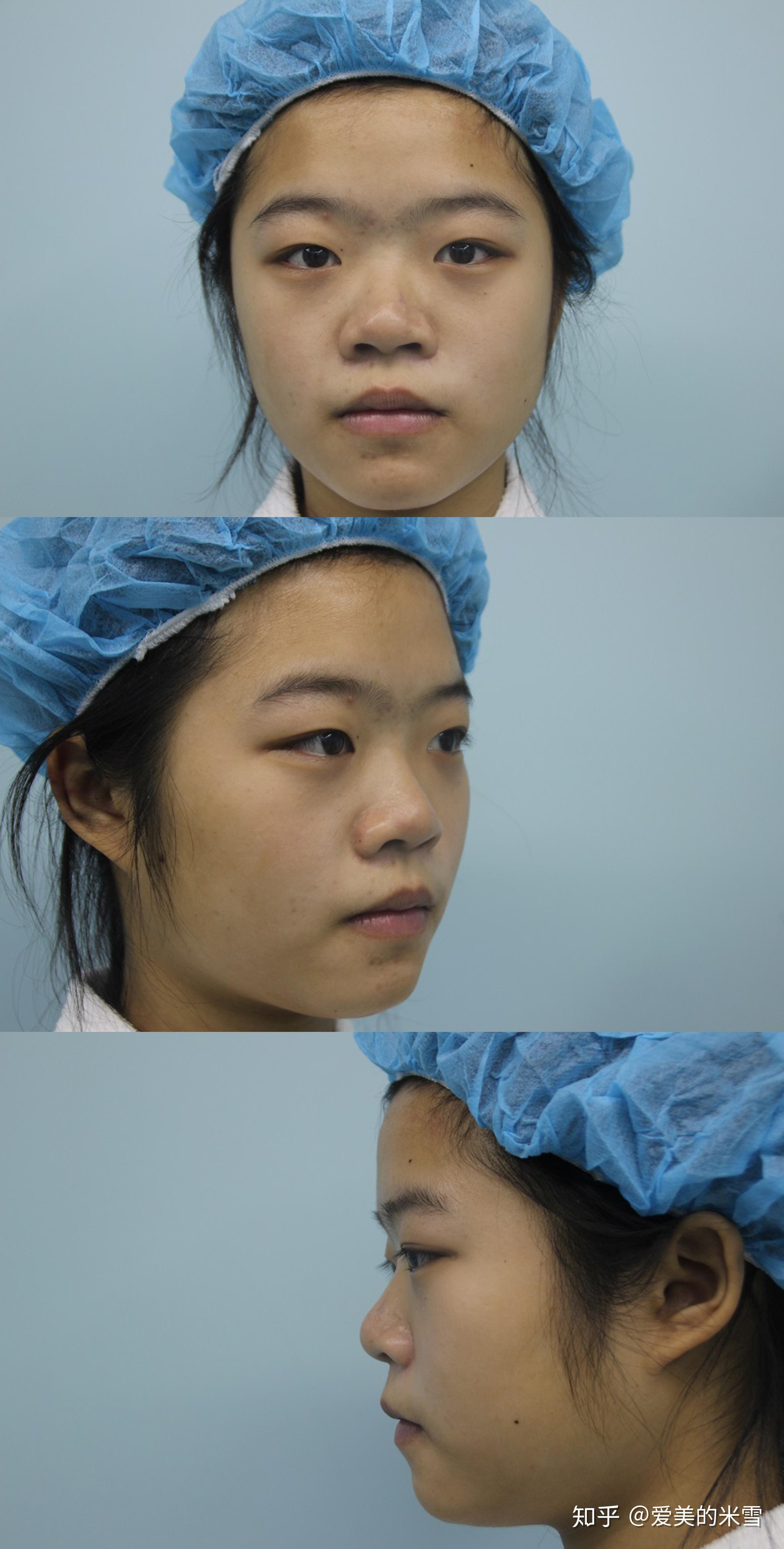 郑东学隆鼻的技术如何?软骨隆鼻例子证实郑东学做鼻子靠谱,隆鼻-8682赴韩整形网