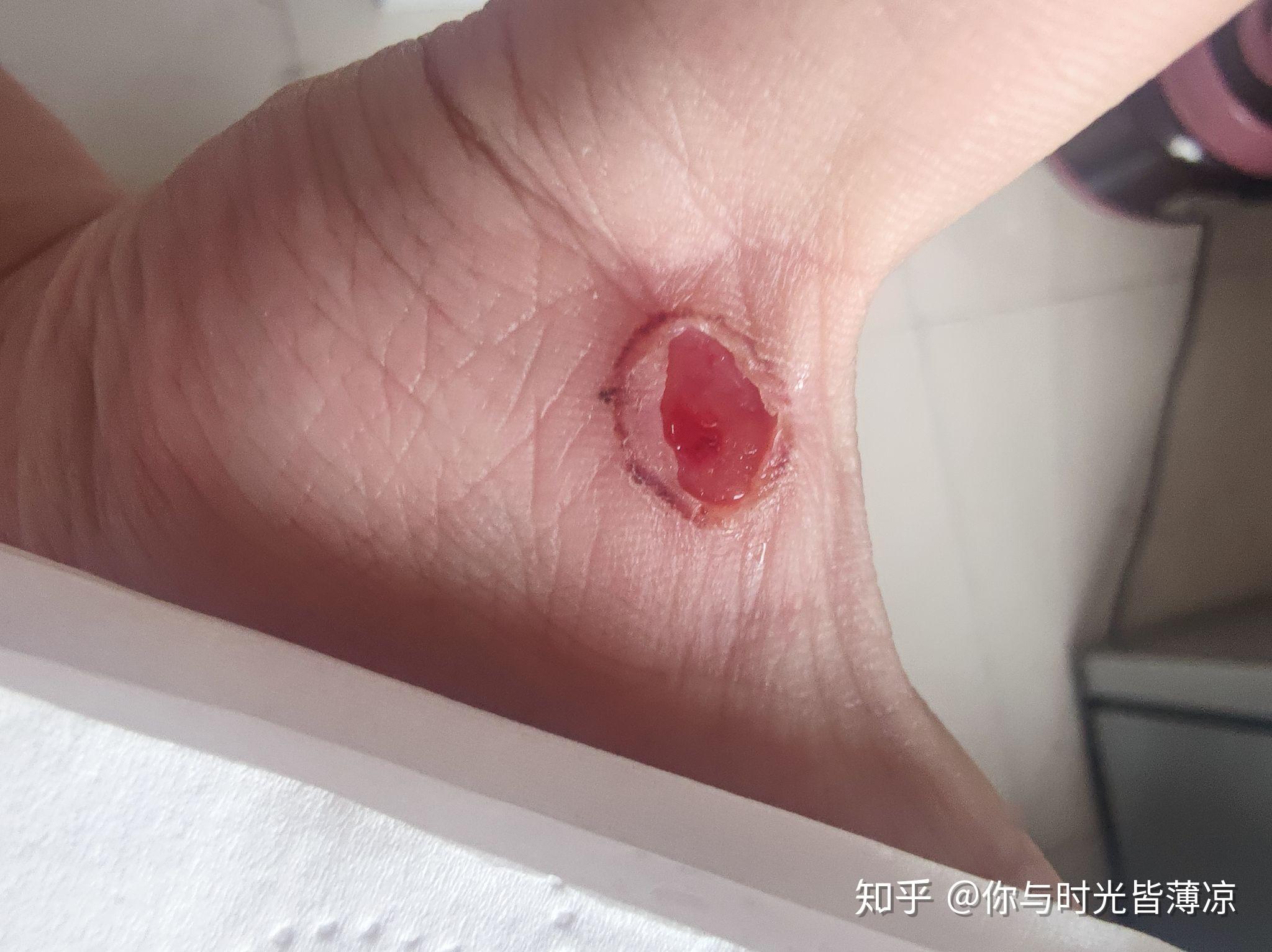 液氮冷冻治疗后手指上出了血泡而且越来越大该怎么办