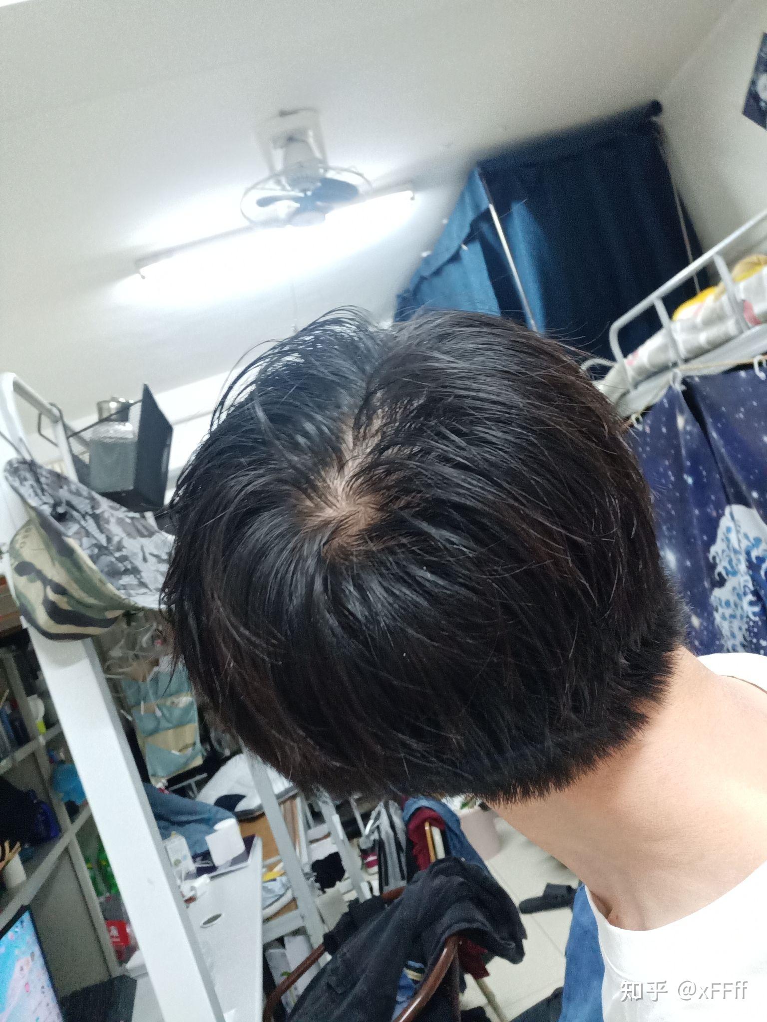 发旋处头发太少了!,我是不是要秃了,怎么办啊! - 知乎