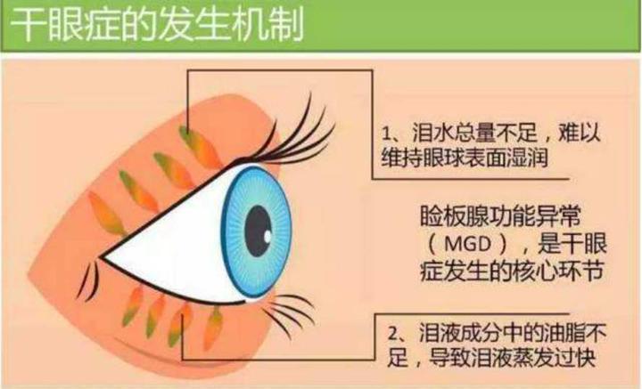 角膜屈光术后常见加项泪液分泌试验和泪膜破裂时间
