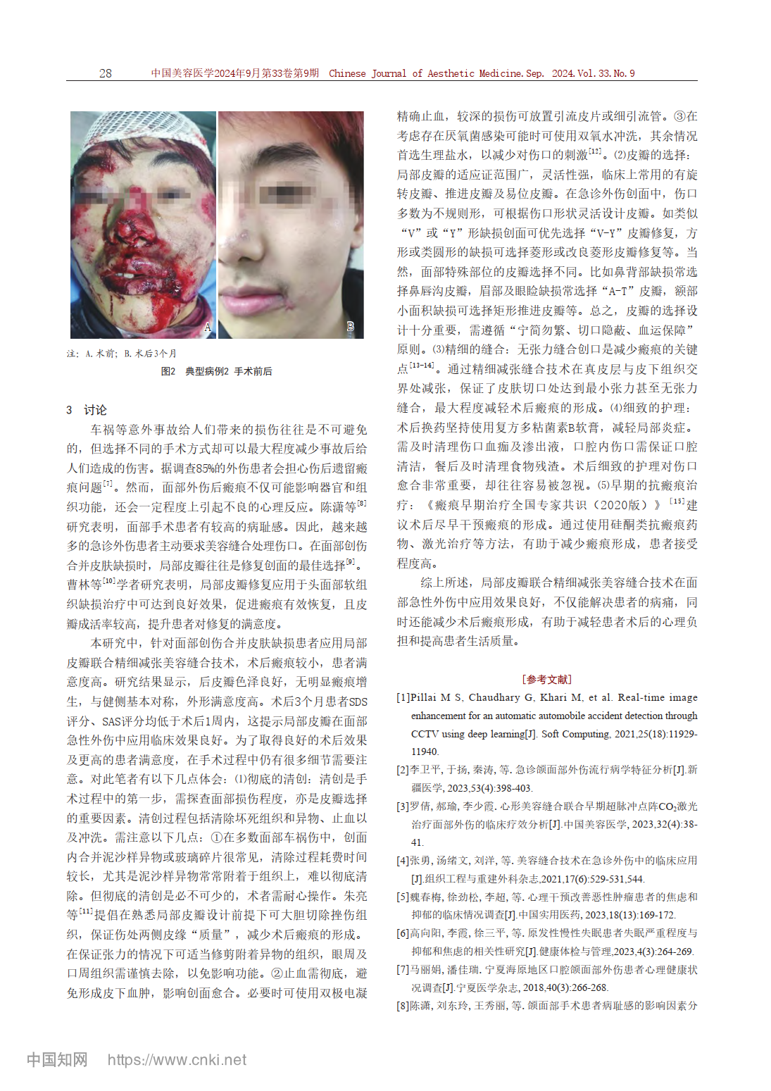 局部皮瓣联合精细减张美容缝合在面部急性外伤修复中的临床应用 - 知乎